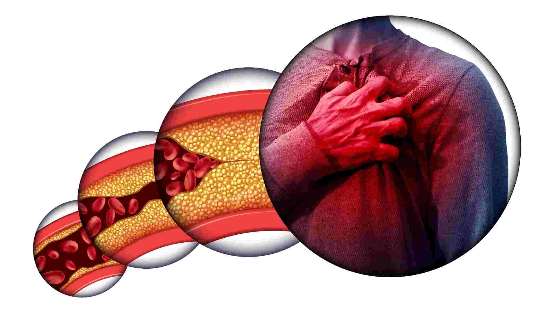 Heart Attack Symptoms