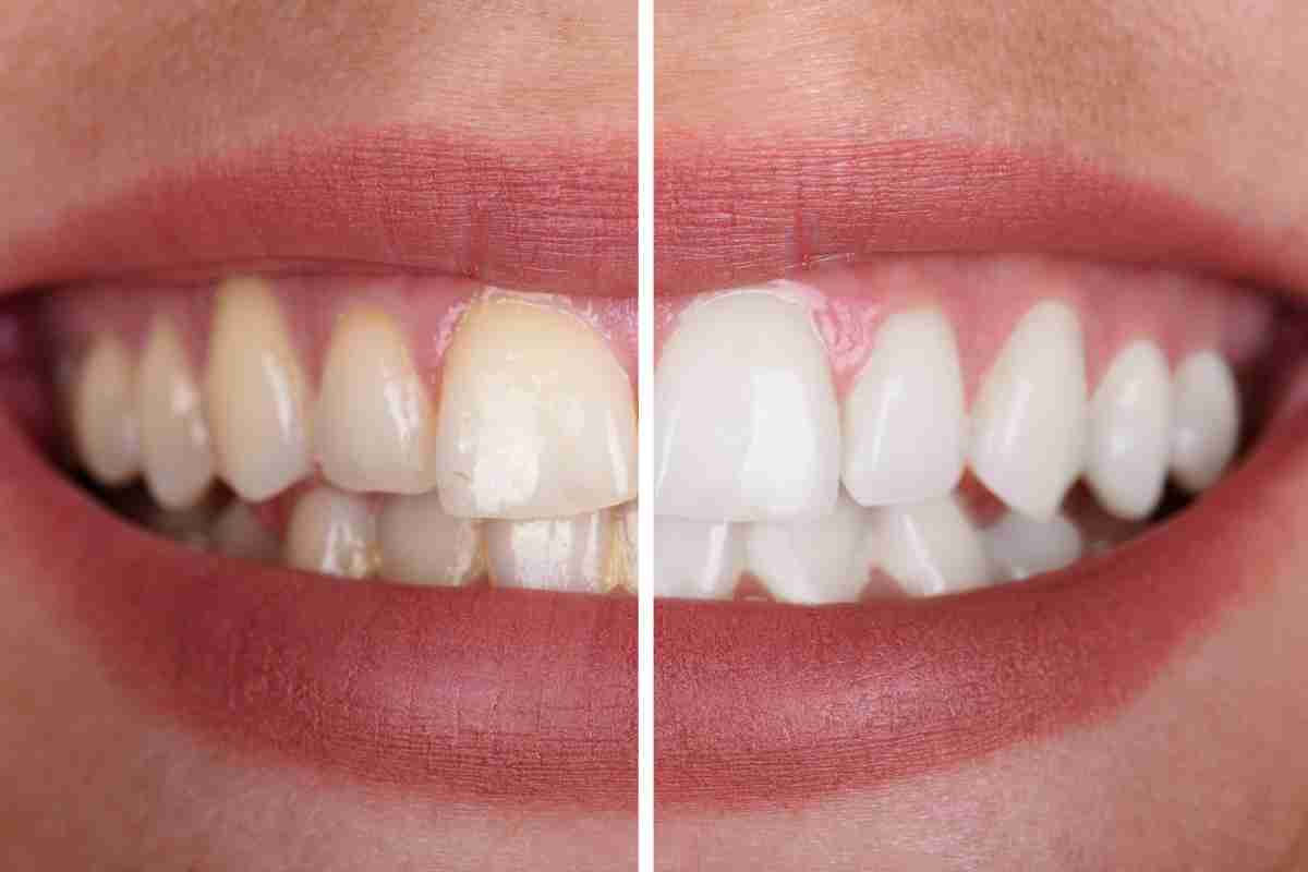 Yellow Teeth Whitening